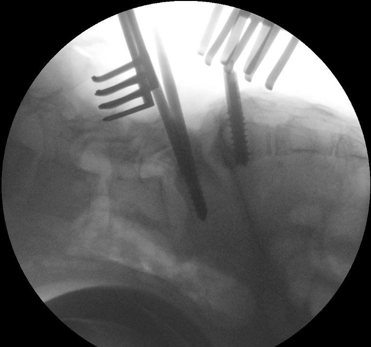 hodnota pelvic incidence (PI) zůstala téměř nezměněna.