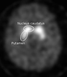 DaTscan - kvantifikace Striatal binding ration C gang = N