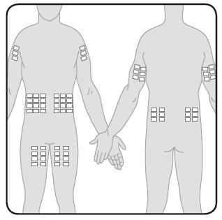 7 Příprava míst(a) podání infuze Vyberte místo(a) podání infuze - Počet a lokalizace míst podání infuze závisí na objemu celkové dávky.