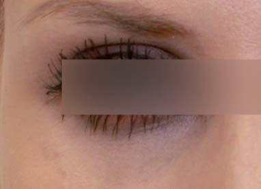 REDENSITY [II] jsou tmavá místa v oblasti očního okolí optimálně vyplněna a