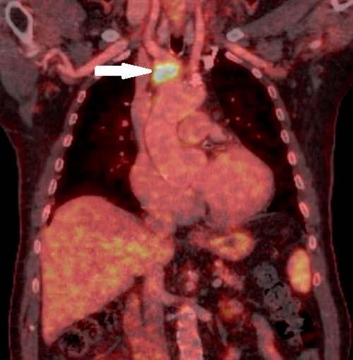 V. Pavliňák, P. Vařejka, J.-C. Lubanda 637 Obr. 3 Vychytávání FDG v oblasti aneurysmatu aorty (bílá šipka) při FDG-PET/CT vyšetření, které odpovídá metabolické aktivitě v místě infekce.