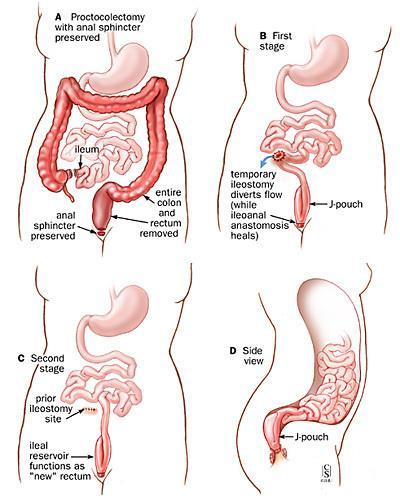 PKE, IPAA u UC v NH 2/3 dobá J pouch staplerová anastamóza protektivní ileostomie