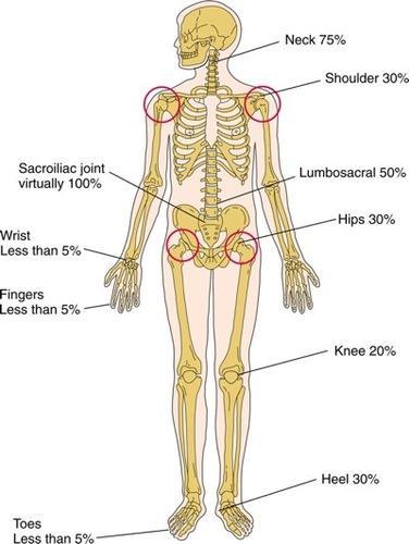 leukocyte antigen - histokompatibilní antigen), který se pohybuje mezi 90 až 95 % v rámci bělošské populace (střední Evropa, Severní Amerika) (Dougados & van der Heijde, 2004). Saraux et al.