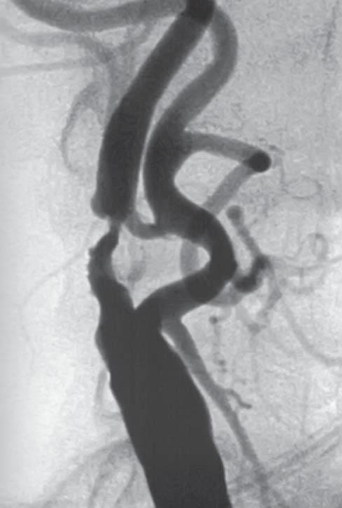 Obrázek 2 Protektivní zařízení FilterWire EZ TM Embolic Protection System v rozvinutém a uzavřeném stavu průtok v karotické arterii byly považovány za kritéria technického úspěchu procedury (obrázky