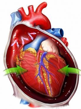 CT hrudníku a břicha HEMOPERIKARD 30 mm, i v okolí ascendentní aorty Aorta bez známek disekce kontuzní změny