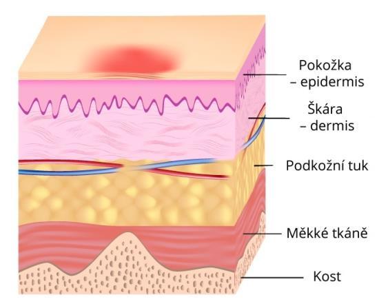 stupně: Zarudnutí kůže /neblednoucí hyperemie erytém Neporušená kůže s lokalizovaným neblednoucím zarudnutím, obvykle nad kostním výčnělkem.