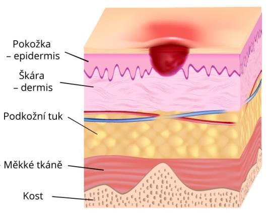 Místo může být bolestivé, tvrdé nebo měkké, teplejší nebo chladnější než ve srovnání s okolní tkání. Dekubitus I. stupně se hůře určuje u lidí s tmavší pletí.