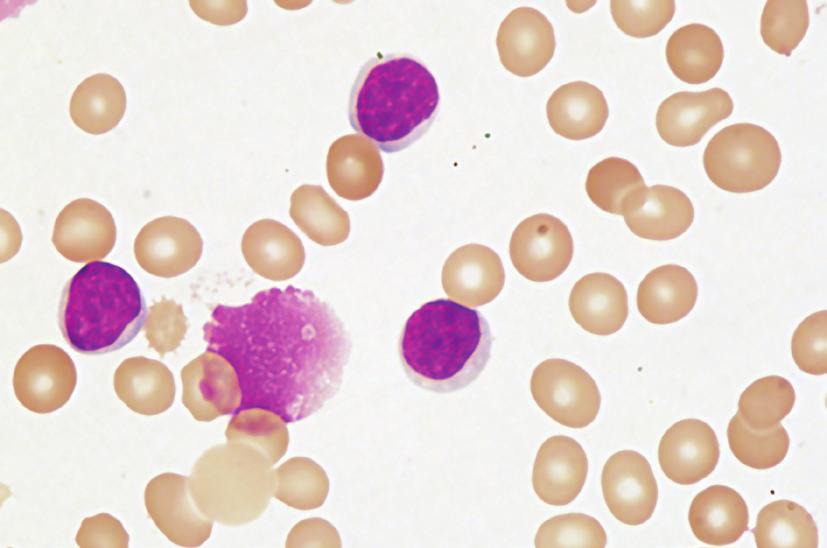I. DIAGNOSTIKA A STANOVENÍ PROGNÓZY Diagnostická kritéria CLL B-lymfocyty v periferní krvi >5x10 9 /l Morfologicky 55 % atypických buněk (např.