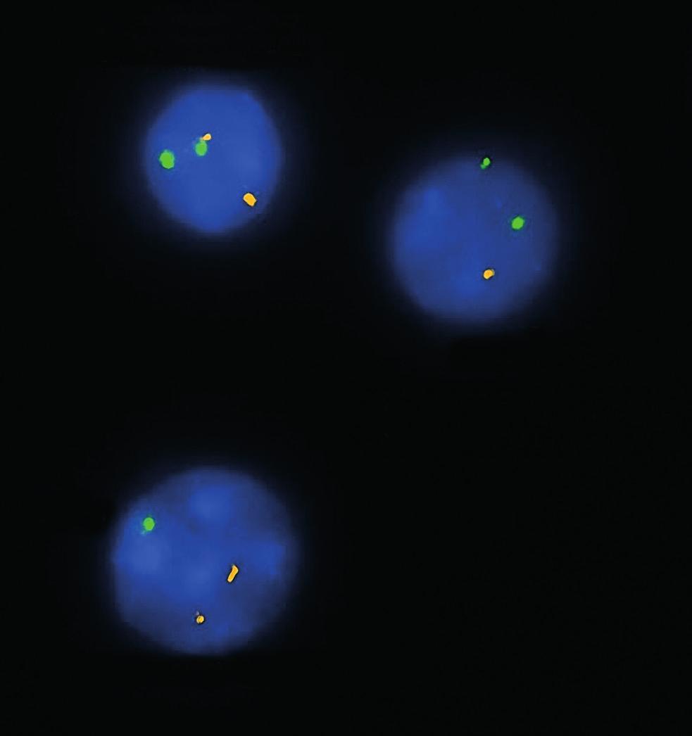 Prognostická vyšetření z periferní krve Fluorescenční in situ hybridizace (FISH delece 13q, 11q, 17p, trisomie 12) Mutační stav genů pro variabilní část těžkého řetězce imunoglobulinu (IGHV)