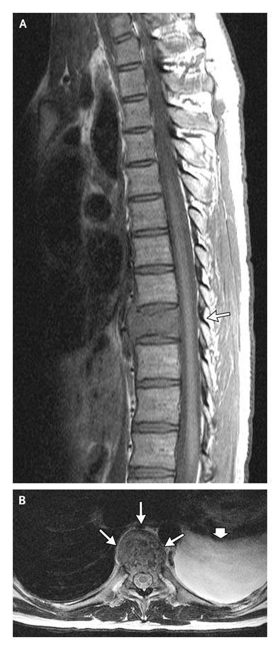 Case study 2 A 26-year-old man was admitted to this hospital because of back pain and a mass in the lung.