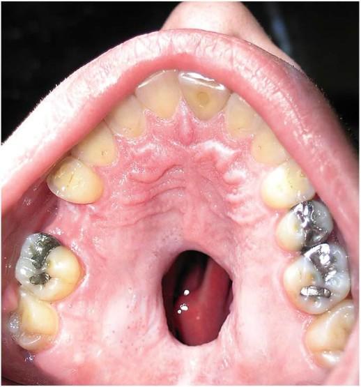 A healthy 25-year-old man presented to the surgical clinic with a hole in the roof of his mouth, present for a year, and he requested surgical correction.