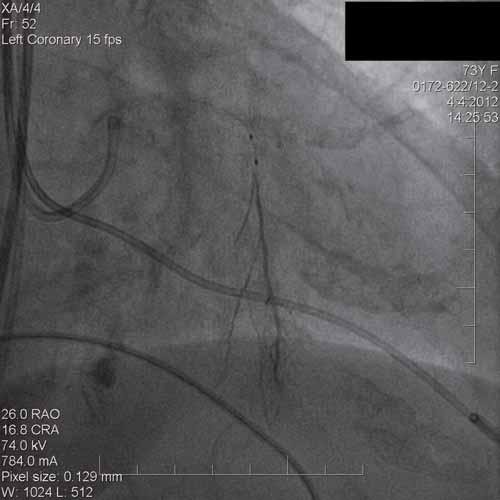496 HKMP a aortální vada případ k septální ablaci, či myektomii A B Obr.