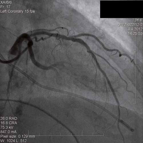 zaveden balon, který byl poté naplněn, a následovala selektivní angiografie s cílem vyloučit, že by zasahoval do ramus interventricularis anterior (RIA) (obr. 2A).