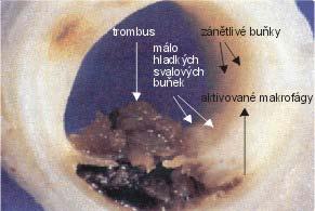 Obr. 9: Ruptura aterosklerotického plátu 2.5. BUNĚČNÉ ADHEZIVNÍ MOLEKULY VCAM-1 Buněčné adhezivní molekuly jsou látky proteinového charakteru, které jsou exprimované na povrchu všech tkání organismu.