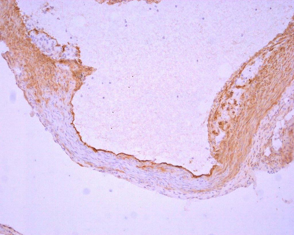 Obr. 14: Imunohistochemické barvení VCAM-1 u kontrolní skupiny zvířat. Silná exprese je pozorována v medii cévy pod aterosklerotický plátem, v plátu a na cévním endotelu. Zvětšení 200x. 5.