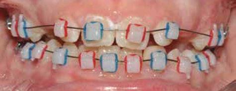 Navíc každý zámek Clarity Ultra je navržen s konturovanou bází specifickou pro každý zub, podobně jako u Clarity Advanced zámků 1, pro lepší naléhání báze na zuby.