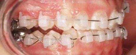 Byly uspořádány praktické kurzy, na kterých ortodontisté vyhodnocovali funkci zámků. Odpovědi účastníků ukázaly, že zámky Clarity Ultra se snadno ligují 1.