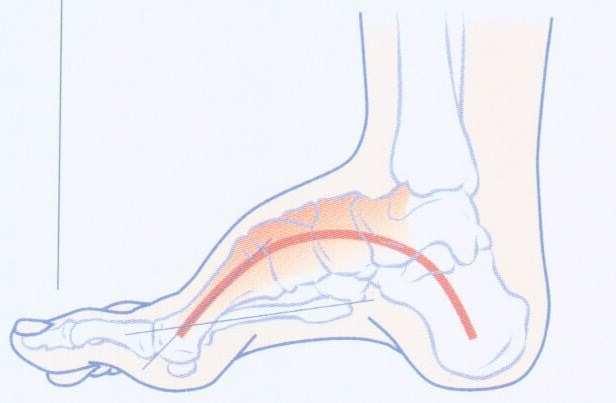 U příčně ploché nohy (pes transversoplanus) (Obrázek 11) dochází ke snížení příčné klenby a přední část nohy se tím pádem rozšiřuje (Larsen, Miescher a Wickihalter, 2009).