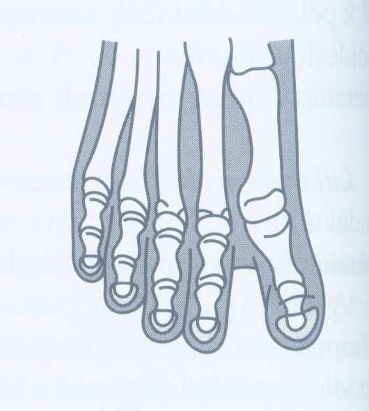 (2006) informují, že ztuhlý palec znamená omezenou pohyblivost v metatarzofalangeálním kloubu palce následkem artritidy nebo artrózy.