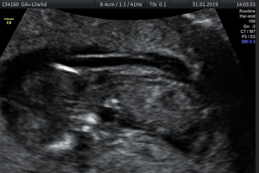 SCREENING V I.TRIMESTRU 31.