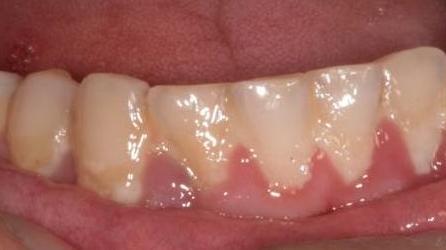 2 Etiologie zánětlivých parodontopatií Označení parodontopatie zahrnuje zánětlivě podmíněná i nezánětlivá onemocnění gingivy a závěsného aparátu zubů.