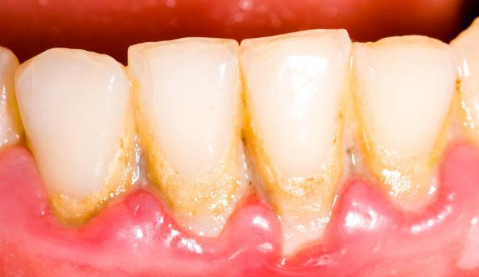 2.2 Zubní kámen a jeho důsledky Zubní kámen je cizorodá látka v dutině ústní, kterou lze prakticky nalézt u každého člověka.