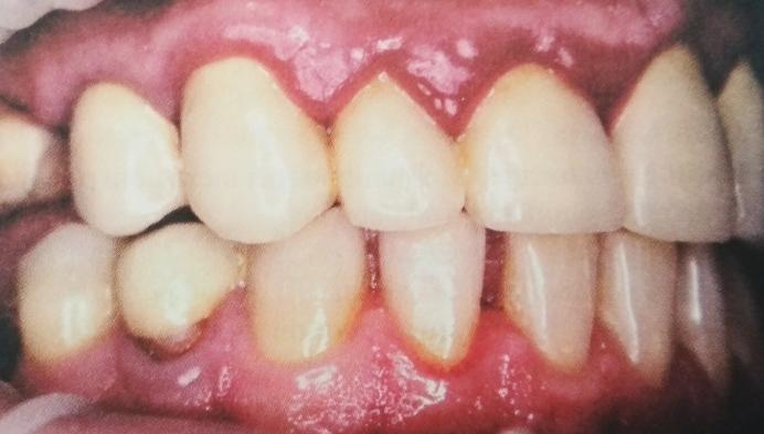 5.1 Plakem podmíněná gingivitida Pokud není zubní plak pečlivě a pravidelně odstraňován, celkový počet mikroorganismů roste a převahu začnou mít agresivní bakterie, které následně vylučují toxické