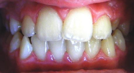 5.1.2 Chronický zánět dásní (gingivitis chronica) Jedná se o nejčastější onemocnění dásní podmíněné zubním plakem, jehož součástí jsou hlavně fakultativně anaerobní gramnegativní bakterie