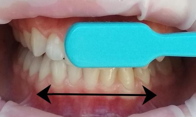 čištění solo technikou. U této techniky se aplikuje mírný tlak na kartáček, čímž se vlákna mírně rozprostřou, a jemnými krouživými pohyby se postupuje podél kontury každého zubu (3, 17).