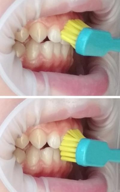 Vlákna kartáčku se přikládají kolmo k povrchu zubu. Nejprve se krouživými pohyby čistí zevní plošky, následně vnitřní plošky zubů a nakonec se vyčistí kousací plochy (3).