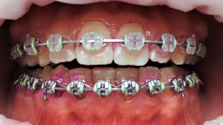10.2 Kazuistika č. 2 Na popud rodičů se na dentální hygienu dostavila mladá pacientka (16 let) s ortodontickým aparátem. Pacientka je zdravá, léky neužívá.