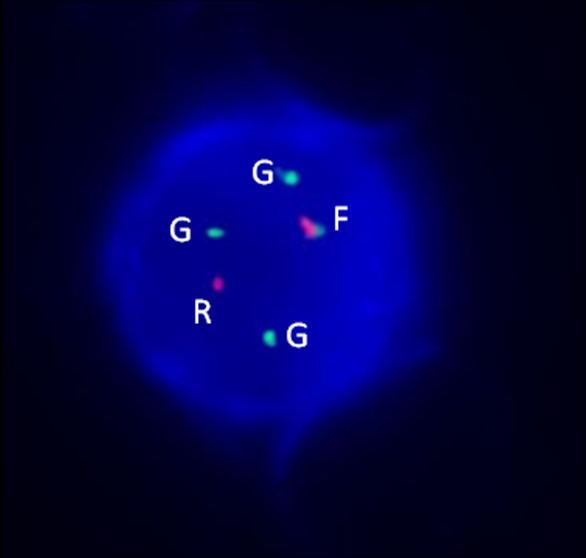 Obrázek č. 41: Ukázka obrazu pro translokaci t(4;14) (1F1R3G) v interfázním jádru. F fúze, R červený signál, G zelený signál U pacienta číslo 9 nebyl prokázán variantní nález.