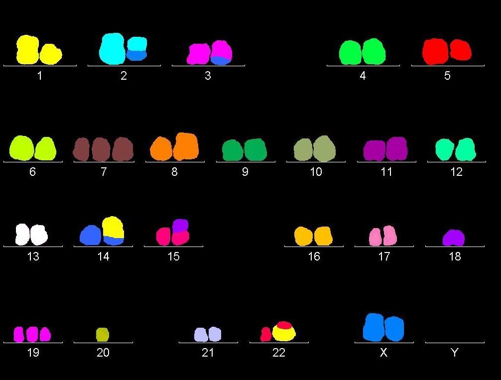 Obrázek č. 45: Výsledek mfish v době progrese (1. klon) mfish karyotyp:48,xx,der(2)t(x;2)(q?26;q?23),der(3)t(3;14)(?;?),del(5)(?q),+7, iso(8)(q10),der(14)t(1;14)(q?11;p?13),?dic(15;18)(p?13;p?11.2),+19, der(22)t(1;22)(q?