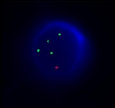 3.4.1 Aneuploidie Obrázek č. 5: Ukázka tetrazomie chromozómu 15 (zelená fluorescence). K detekci chromozómu se používají centromerické sondy. V našem případě na obrázku č.