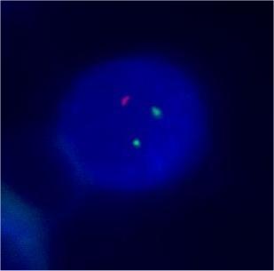3.4.2 Abnormality chromozómu 13 Obrázek č. 6: Ukázka delece genu RB1 (červené spektrum).