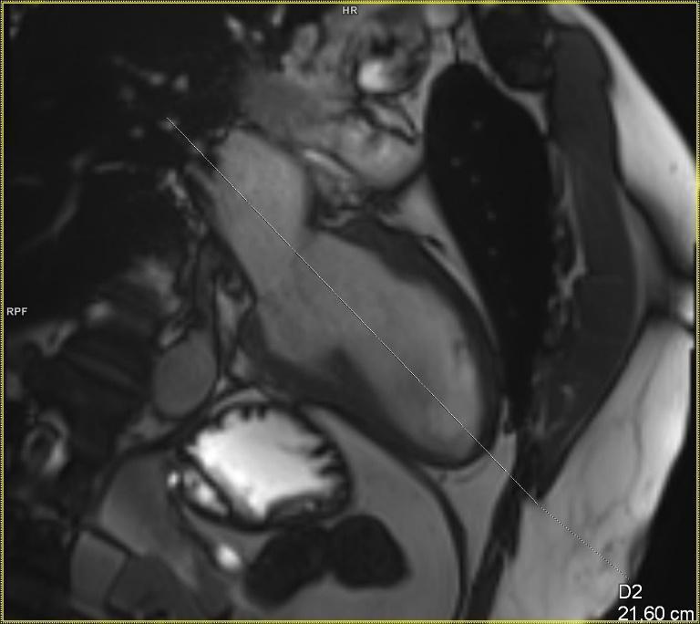 obrázek č. 2 - Dvoudutinová projekce při MR vyšetření srdce, tenké linie vyznačuje průběh čtyřdutinové projekce. Zdroj: Klinika zobrazovacích metod (doc. MUDr.