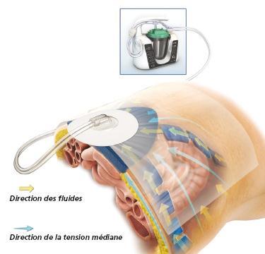 ABThera OA NPT Laparotomy management using the