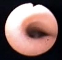 dýchacích cest a cév Malacie dýchacích cest