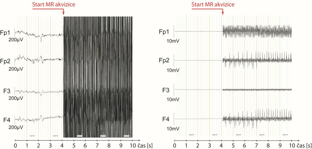 k repetičnímu času TR jednotlivých funkčních MR snímků) a díky časové synchronizaci obou modalit je i vzorkovaný vždy ve stejné fázi.