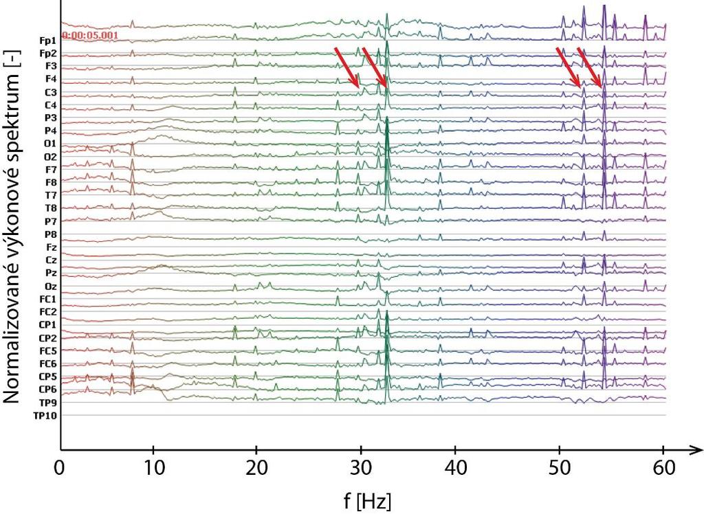 79]. Ukázka normalizovaného výkonového spektra EEG signálu, ve kterém jsou vidět výrazné hroty způsobené tímto artefaktem je na obrázku 11.