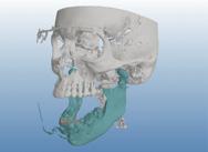 frontálních, sagitálních a axiálních pohybů a ve 3D Porovnání digitálních zubních otisků s CBCT snímkem pro lepší vizualizaci Informace o pohybech a výsledky měření lze