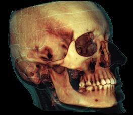 Pooperativní a následné snímkování v maxilofaciální chirurgii 3D snímkování s nižší účinnou dávkou záření než u panoramatického snímkování Planmeca ProMax 3D Mid FOV Ø 200 x 170 mm / Velikost voxelu