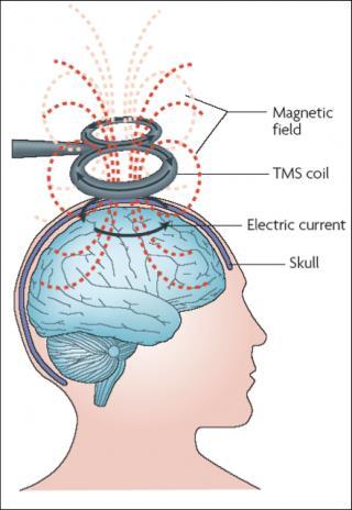 kortikální excitability Efekt rtms na hypokinetickou dysartrii zkoumalo dosud