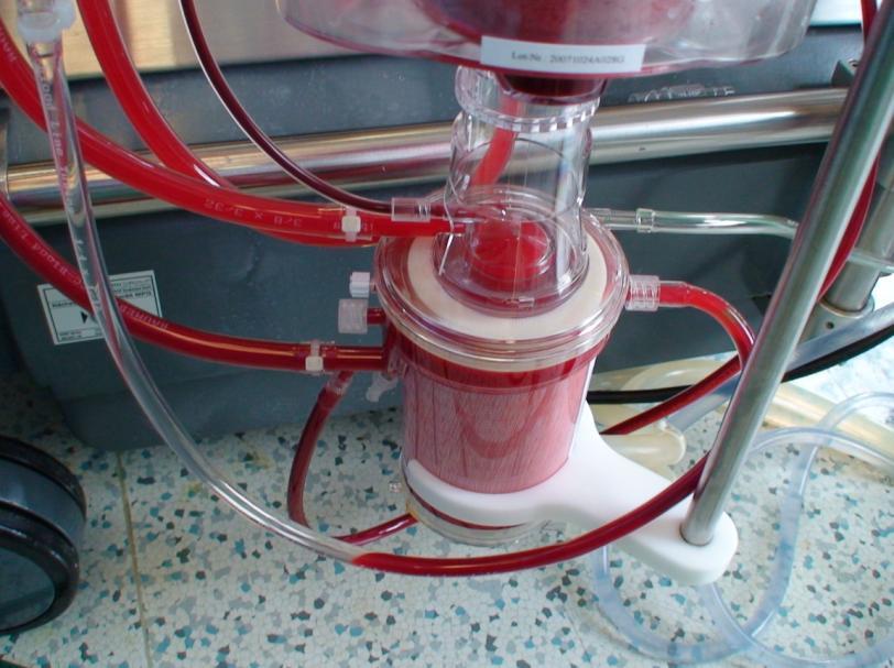2.3.3. Pumpa (čerpadlo) K vypuzování krve zpět do cévního systému pacienta je třeba čerpadla. Používají se dva typy čerpadel. Rotační válečková pumpa jedná se o nejpoužívanější pumpu.