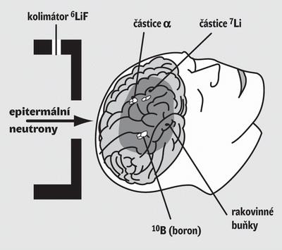 Využití sloučenin boru v terapii nádorů Borová neutronová záchytová terapie - NBCT 10 B(n, ) 7 Li U mozkových nádorů je nejprve do pacientova těla injekčně vpravena borová sloučenina, která má tu