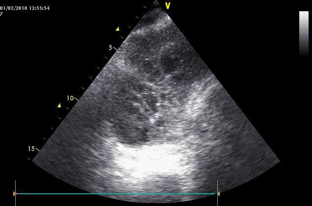 Nejčastější indikace k drenáži hrudníku Tekutina: Fluidothorax (transudát, exsudát) Pyothorax Hemothorax Indikace k drenáži dána Hemotoraxem Pyothoraxem Kvantitou u