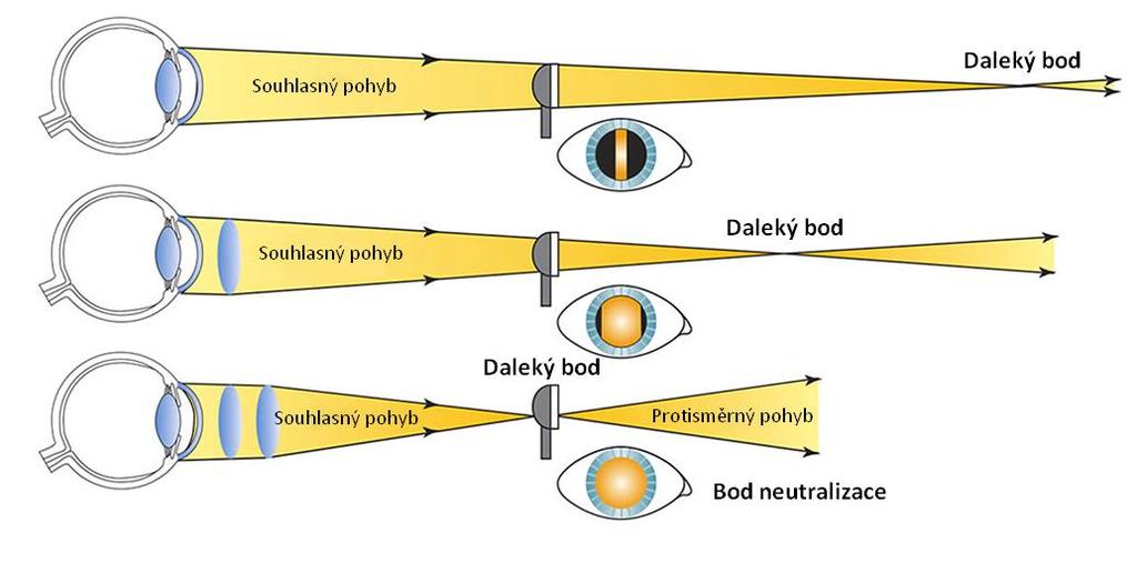 neutralizace je potřeba pomocí spojných čoček upravit chod paprsků tak, aby poloha dalekého bodu sloučeného optického systému oka a předřazené korekční čočky se posunula blíže, přesněji do roviny