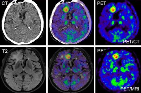 Zobrazení glioblastomu pomocí hybridních metod (Zdroj: Simultaneous PET/MRI creates diagnostic-quality images, AuntMinnieEurope.com) 4.