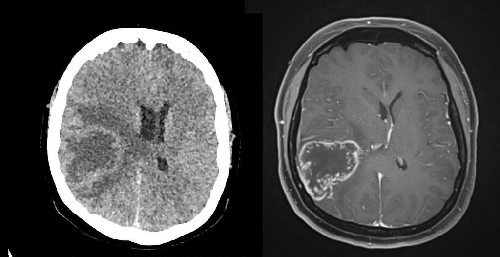 kraniotomie, PET/CT (10. 5. 2016) a MR (30. 4.