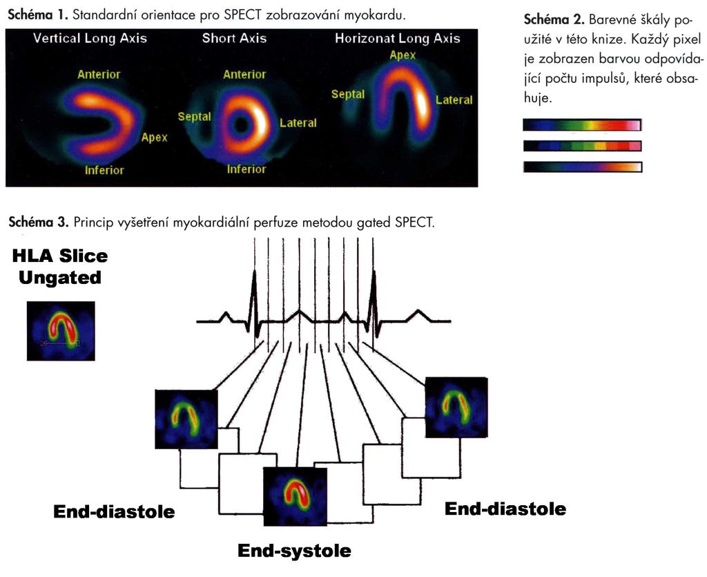 Příloha 5: Gated SPECT 3D zobrazení.